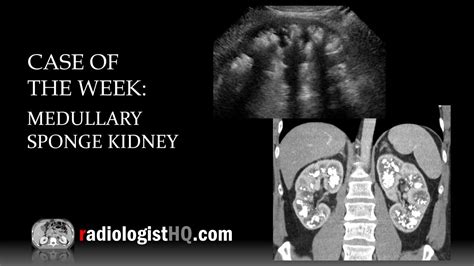 medullary sponge kidney ultrasound appearance.